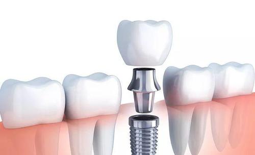 为什么种植牙齿价格那么高,种植牙的利和弊和价格