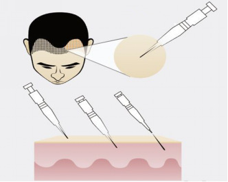 怎样毛发种植技术,种植毛发效果
