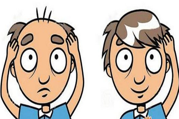 毛发种植的特点,怎样毛发种植技术