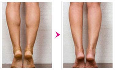 腿部抽脂多久可以喝酒,大腿抽脂一个月喝酒有什么后果