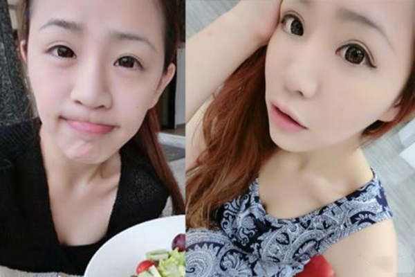 我做了上睑松弛整形术,做完上睑下垂手术该注意什么