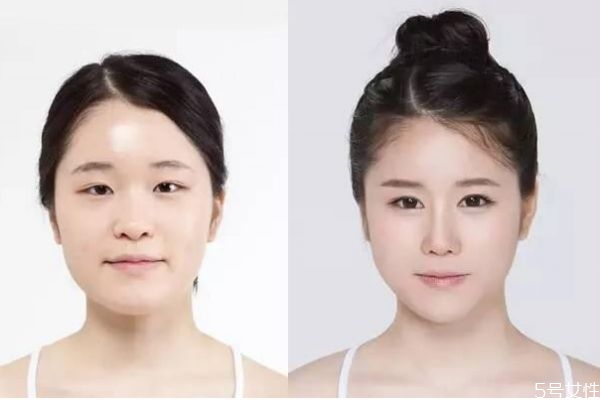 垫鼻梁老了以后会怎样,垫鼻子老了有什么影响 垫鼻梁老了以后会怎样,垫鼻子老了有什么影响