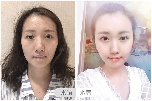 丰苹果肌什么方法最好,玻尿酸填充苹果肌注意事项