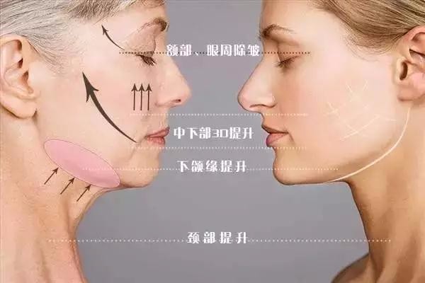 吸脂后皮肤松弛怎么解决,吸脂肪后皮肤松弛怎么办 吸脂后皮肤松弛怎么解决,吸脂肪后皮肤松弛怎么办