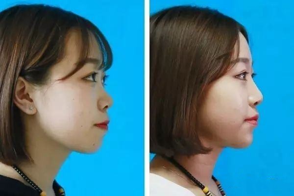 自体脂肪丰下巴效果怎么样,自体脂肪丰下巴多少钱? 自体脂肪丰下巴效果怎么样,自体脂肪丰下巴多少钱?