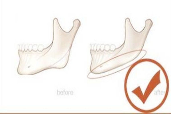 下颌角手术后多久消肿,下颚角手术多久消肿