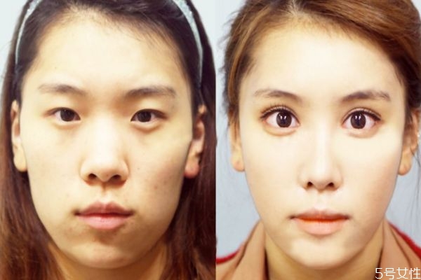 手术的副作用,做手术的危害