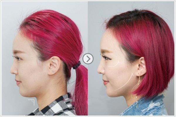 电波拉皮多久有效果,电波拉皮效果好吗能维持多久