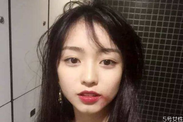 开内眼角用什么祛疤膏,开眼角要用祛疤痕膏吗