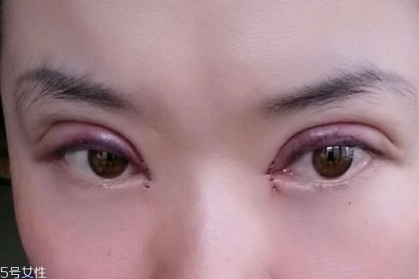 割双眼皮注意哪些,割双眼皮割双眼皮注意事项 割双眼皮注意哪些,割双眼皮割双眼皮注意事项