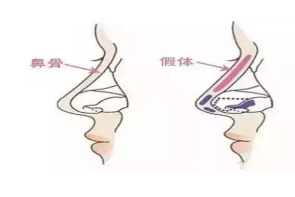 膨体隆鼻过程,膨体隆鼻的膨体是什么东西