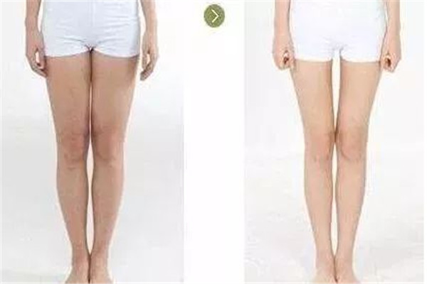 瘦腿针打三次能永久吗,瘦腿针多长时间打一次还是可以永久