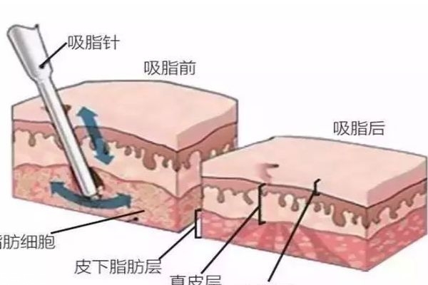 水动力吸脂一般需要多少钱,水动力吸脂手术效果怎么样