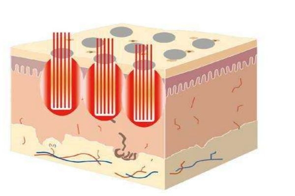 点阵激光危害大吗,点阵激光有危险吗