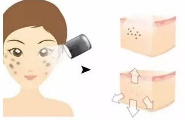 光子嫩肤是什么原理,光子嫩肤的原理和作用