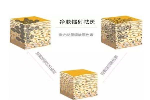 镭射净肤多久做一次,柔肤镭射多少钱一次