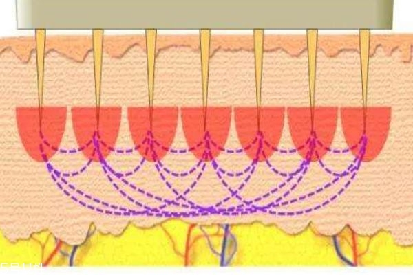 微针的作用是什么,微针有用吗