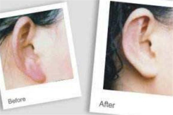 玻尿酸丰耳垂前后对比,玻尿酸丰耳垂前后对比图 玻尿酸丰耳垂前后对比,玻尿酸丰耳垂前后对比图