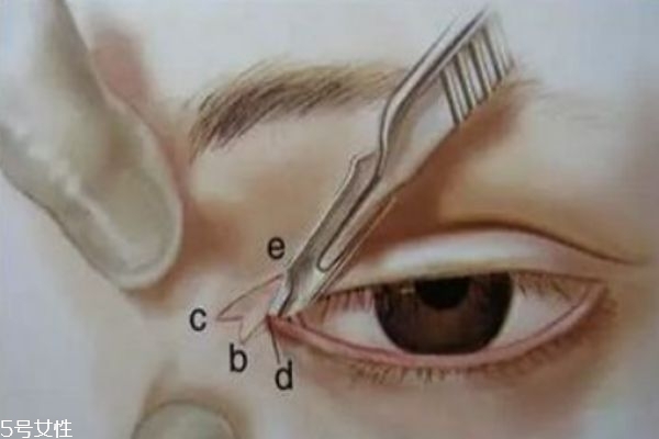 开眼角要注意事项有哪些,什么样需要开眼角