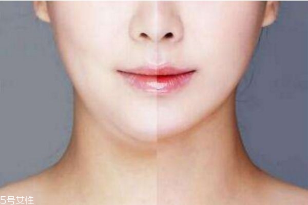 脸可以抽脂吗,做脸部抽脂好吗