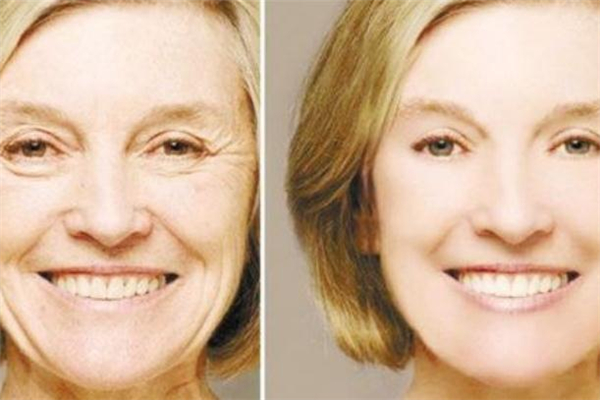 注射羊胎素会有哪些副作用,注射羊胎素的作用和功效 注射羊胎素会有哪些副作用,注射羊胎素的作用和功效