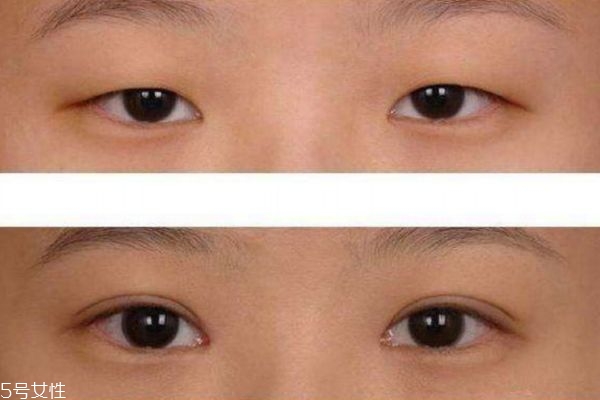 老年人眼睑下垂的治疗方法,下眼皮松弛下垂怎么办