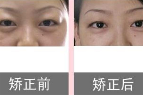 上眼皮抽脂前后对比,眼部抽脂前后对比 上眼皮抽脂前后对比,眼部抽脂前后对比