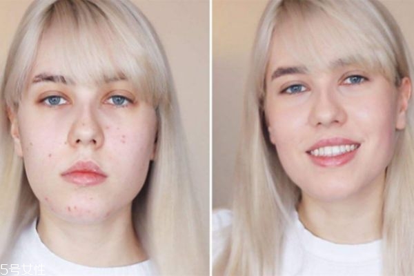 激光祛痘印的原理是什么,激光去痘印的原理