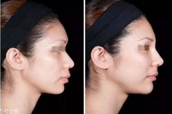 达拉斯隆鼻前后图,达拉斯隆鼻全过程 达拉斯隆鼻前后图,达拉斯隆鼻全过程