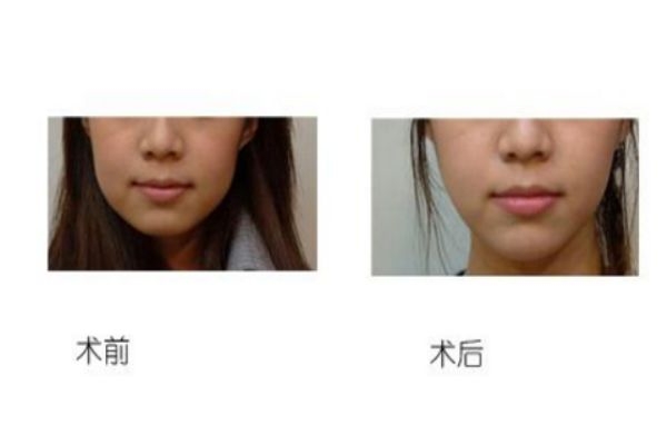 垫下巴的优缺点,垫下巴的好处