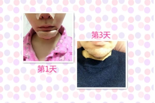 垫下巴后恢复过程图解,垫下巴恢复期多久