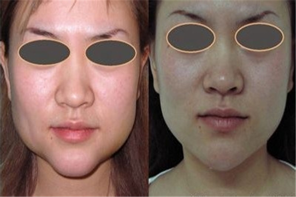 瘦脸针一边脸打几针,瘦脸针注射正确几个点