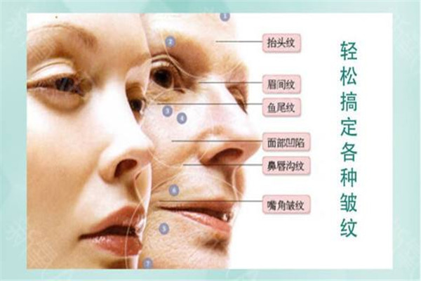 肉毒素可以注射哪些部位,肉毒素可以注射哪些部位图片 肉毒素可以注射哪些部位,肉毒素可以注射哪些部位图片