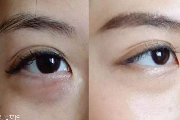 去眼袋内切和外切区别,内路眼袋和外路眼袋的区别