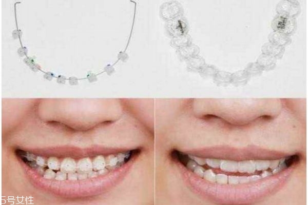 什么牙齿可以整形,牙齿整形有几种方法