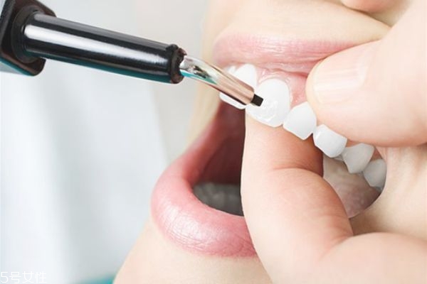 牙齿矫正注意事项,牙齿整形注意事项