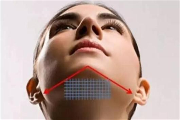 双下巴做线雕效果好吗,双下巴吸脂好还是线雕好