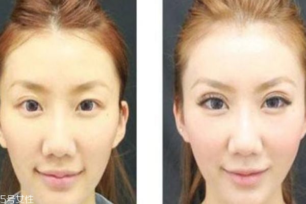 全切双眼皮为什么会有肉条,双眼皮手术后肉条