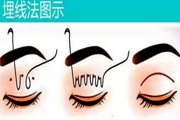 埋线好还是韩式三点好,韩式埋线能维持多久