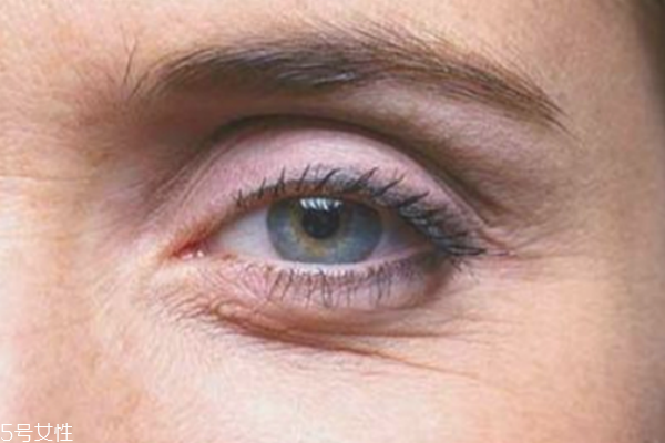 鱼尾纹能打玻尿酸吗,玻尿酸填充鱼尾纹缺点