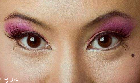 激光点痣介绍,什么是激光点痣