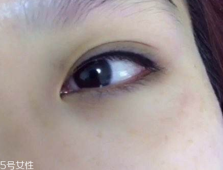 纹美瞳线肿了怎样消肿,纹美瞳线怎么能快速消肿 纹美瞳线肿了怎样消肿,纹美瞳线怎么能快速消肿