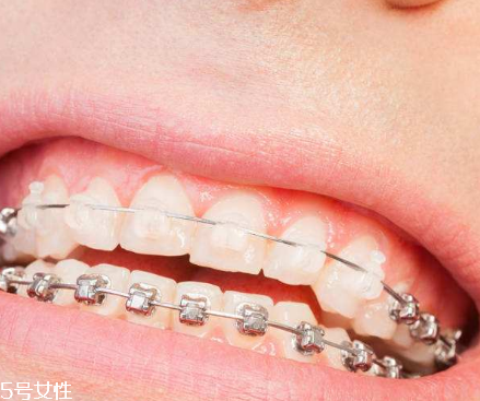 牙齿矫正器有哪几种,myobrace牙齿矫正器