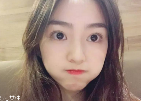 冬天割双眼皮需要注意什么,冬天割双眼皮好恢复不