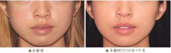 打瘦脸针视频全过程,瘦脸针瘦脸过程图片