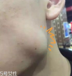 瘦脸针蛙腮怎么补救,打完瘦脸针蛙腮怎么办 瘦脸针蛙腮怎么补救,打完瘦脸针蛙腮怎么办