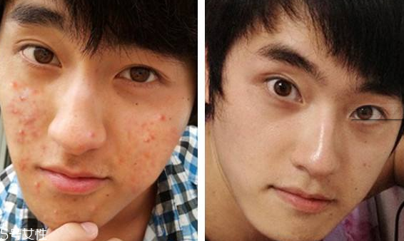 祛痘手术真的有用吗,手术祛痘多少钱呢 祛痘手术真的有用吗,手术祛痘多少钱呢