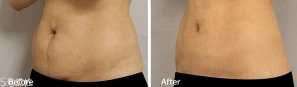 打了溶脂针要注意什么,溶脂的注意事项