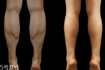 瘦小腿的手术,瘦小腿的整形手术