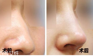 鼻子打玻尿酸有什么用,玻尿酸隆鼻的优点和缺点